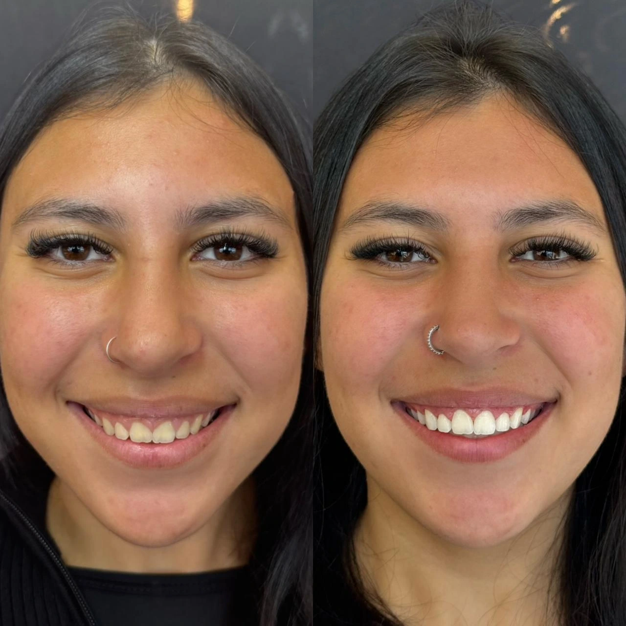 gengivoplastia gengivoplastia